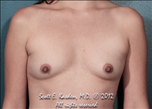 Breast Augmentation Before Photo by Scott Kasden, MD; Argyle, TX - Case 25309