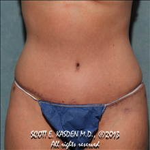 Tummy Tuck After Photo by Scott Kasden, MD; Argyle, TX - Case 25310