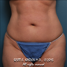 Tummy Tuck Before Photo by Scott Kasden, MD; Argyle, TX - Case 25310