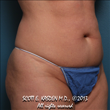 Tummy Tuck Before Photo by Scott Kasden, MD; Argyle, TX - Case 25310