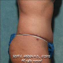 Tummy Tuck After Photo by Scott Kasden, MD; Argyle, TX - Case 25310