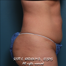 Tummy Tuck Before Photo by Scott Kasden, MD; Argyle, TX - Case 25310