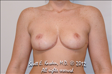Breast Lift After Photo by Scott Kasden, MD; Argyle, TX - Case 25329