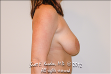 Breast Lift Before Photo by Scott Kasden, MD; Argyle, TX - Case 25329