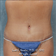 Tummy Tuck After Photo by Scott Kasden, MD; Argyle, TX - Case 25345