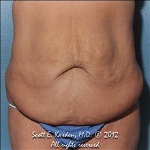 Tummy Tuck Before Photo by Scott Kasden, MD; Argyle, TX - Case 25345