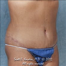 Tummy Tuck After Photo by Scott Kasden, MD; Argyle, TX - Case 25345