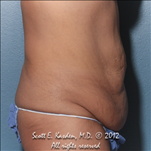 Tummy Tuck Before Photo by Scott Kasden, MD; Argyle, TX - Case 25345
