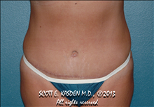 Tummy Tuck After Photo by Scott Kasden, MD; Argyle, TX - Case 25408