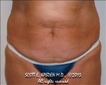 Tummy Tuck Before Photo by Scott Kasden, MD; Argyle, TX - Case 25408