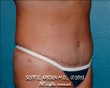 Tummy Tuck After Photo by Scott Kasden, MD; Argyle, TX - Case 25408