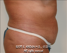 Tummy Tuck Before Photo by Scott Kasden, MD; Argyle, TX - Case 25408