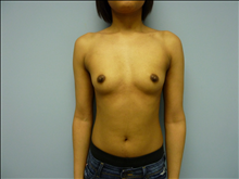 Breast Augmentation Before Photo by Florence Mussat, MD; Chicago, IL - Case 24742