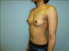 Breast Augmentation Before Photo by Florence Mussat, MD; Chicago, IL - Case 24742