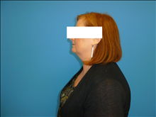 Liposuction Before Photo by Florence Mussat, MD; Chicago, IL - Case 24743