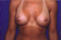 Breast Augmentation After Photo by Andrew Giacobbe, MD; Williamsville, NY - Case 9309