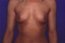 Breast Augmentation Before Photo by Andrew Giacobbe, MD; Williamsville, NY - Case 9309
