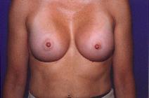 Breast Augmentation After Photo by Andrew Giacobbe, MD; Williamsville, NY - Case 9312
