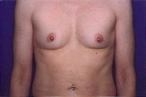 Breast Augmentation Before Photo by Andrew Giacobbe, MD; Williamsville, NY - Case 9312