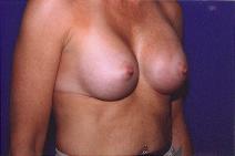 Breast Augmentation After Photo by Andrew Giacobbe, MD; Williamsville, NY - Case 9312