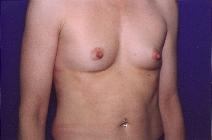 Breast Augmentation Before Photo by Andrew Giacobbe, MD; Williamsville, NY - Case 9312