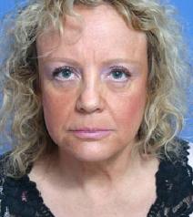 Facelift Before Photo by Anthony Youn, MD; Troy, MI - Case 7371