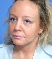 Facelift After Photo by Anthony Youn, MD; Troy, MI - Case 7371