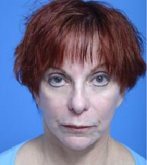 Facelift Before Photo by Anthony Youn, MD; Troy, MI - Case 7373