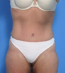Tummy Tuck After Photo by Anthony Youn, MD; Troy, MI - Case 7375