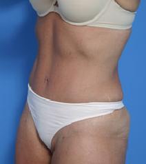 Tummy Tuck After Photo by Anthony Youn, MD; Troy, MI - Case 7375
