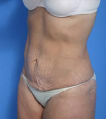 Tummy Tuck Before Photo by Anthony Youn, MD; Troy, MI - Case 7375