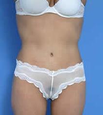 Tummy Tuck After Photo by Anthony Youn, MD; Troy, MI - Case 7376