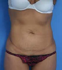 Tummy Tuck Before Photo by Anthony Youn, MD; Troy, MI - Case 7376