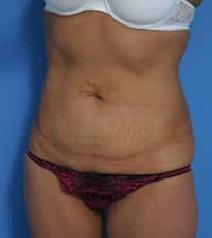 Tummy Tuck Before Photo by Anthony Youn, MD; Troy, MI - Case 7376