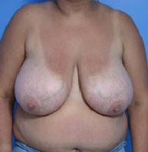 Breast Reduction Before Photo by Anthony Youn, MD; Troy, MI - Case 7379