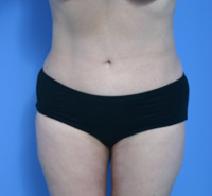 Liposuction After Photo by Anthony Youn, MD; Troy, MI - Case 7380