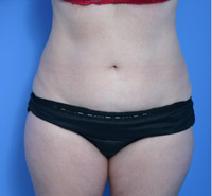 Liposuction Before Photo by Anthony Youn, MD; Troy, MI - Case 7380