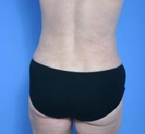 Liposuction After Photo by Anthony Youn, MD; Troy, MI - Case 7380