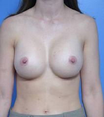 Breast Augmentation After Photo by Anthony Youn, MD; Troy, MI - Case 7382