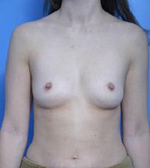 Breast Augmentation Before Photo by Anthony Youn, MD; Troy, MI - Case 7382
