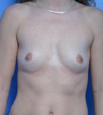 Breast Augmentation Before Photo by Anthony Youn, MD; Troy, MI - Case 7384