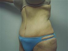 Tummy Tuck After Photo by Christopher Constance, MD, FACS; Port Charlotte, FL - Case 28699
