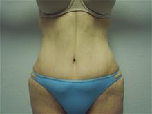Tummy Tuck After Photo by Christopher Constance, MD, FACS; Port Charlotte, FL - Case 28699