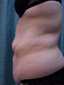 Tummy Tuck Before Photo by Christopher Constance, MD, FACS; Port Charlotte, FL - Case 28699