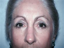 Eyelid Surgery After Photo by Christopher Constance, MD, FACS; Port Charlotte, FL - Case 28700