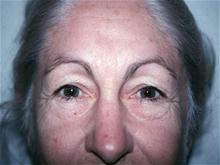 Eyelid Surgery Before Photo by Christopher Constance, MD, FACS; Port Charlotte, FL - Case 28700