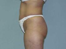 Tummy Tuck Before Photo by William Dascombe, MD; Savannah, GA - Case 2078