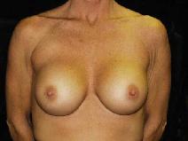 Breast Augmentation After Photo by William Dascombe, MD; Savannah, GA - Case 2097