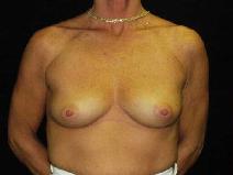 Breast Augmentation Before Photo by William Dascombe, MD; Savannah, GA - Case 2097