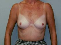 Breast Augmentation Before Photo by William Dascombe, MD; Savannah, GA - Case 2116